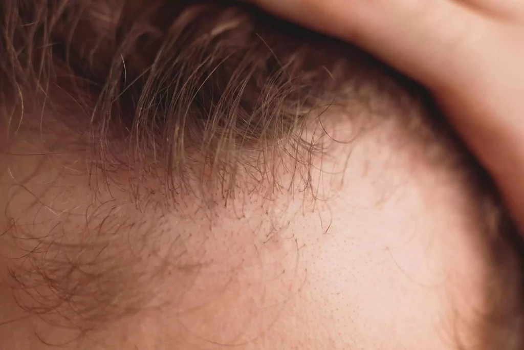 how-long-does the-recovery-after hair-transplant- take